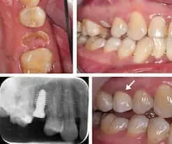 Failing Fractured Upper Right Premolar