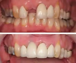 Upper Right Front Tooth Single Dental Implant