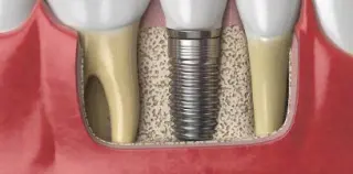 Affordable Dental Implants in Salinas, CA